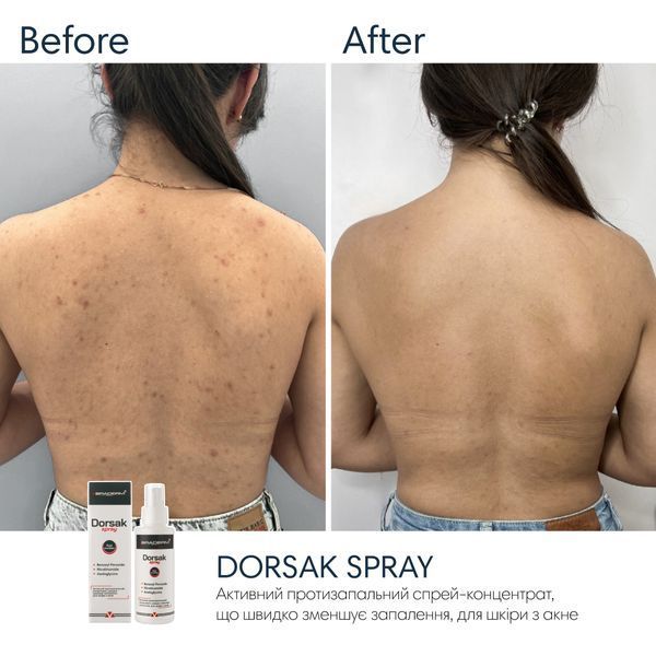 Спрей-концентрат для тіла з бензоїл пероксидом Braderm Dorsak Spray A00244 фото