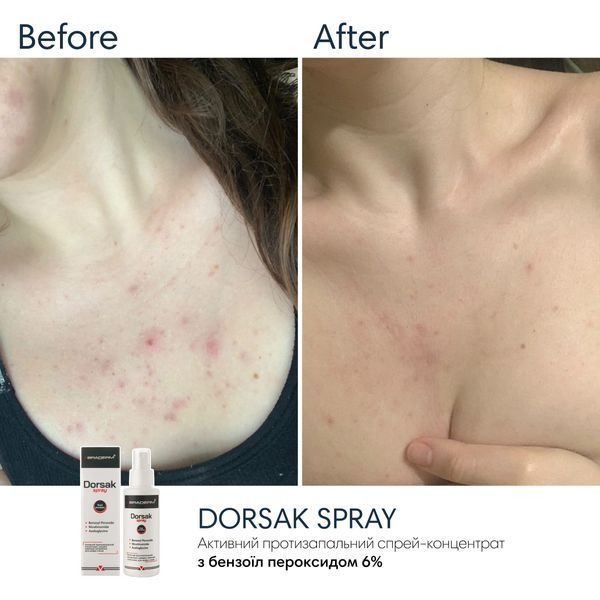 Спрей-концентрат для тіла з бензоїл пероксидом Braderm Dorsak Spray A00244 фото