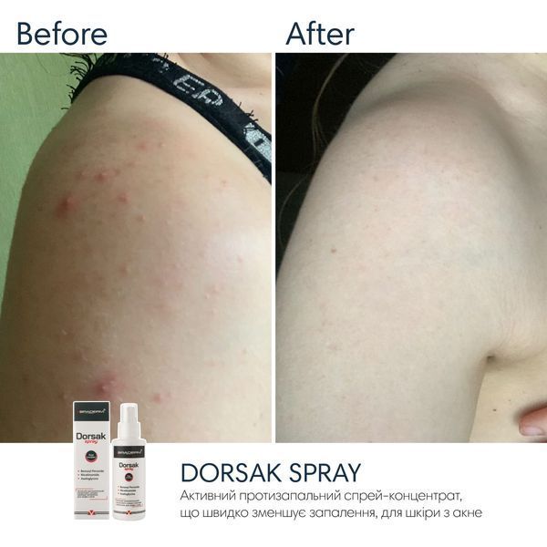 Спрей-концентрат для тіла з бензоїл пероксидом Braderm Dorsak Spray A00244 фото