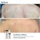 Спрей-концентрат для тіла з бензоїл пероксидом Braderm Dorsak Spray A00244 фото 5