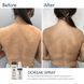 Спрей-концентрат для тіла з бензоїл пероксидом Braderm Dorsak Spray A00244 фото 2
